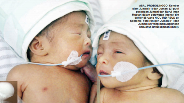 Usai Dioperasi, Kondisi Bayi Kembar Siam Membaik