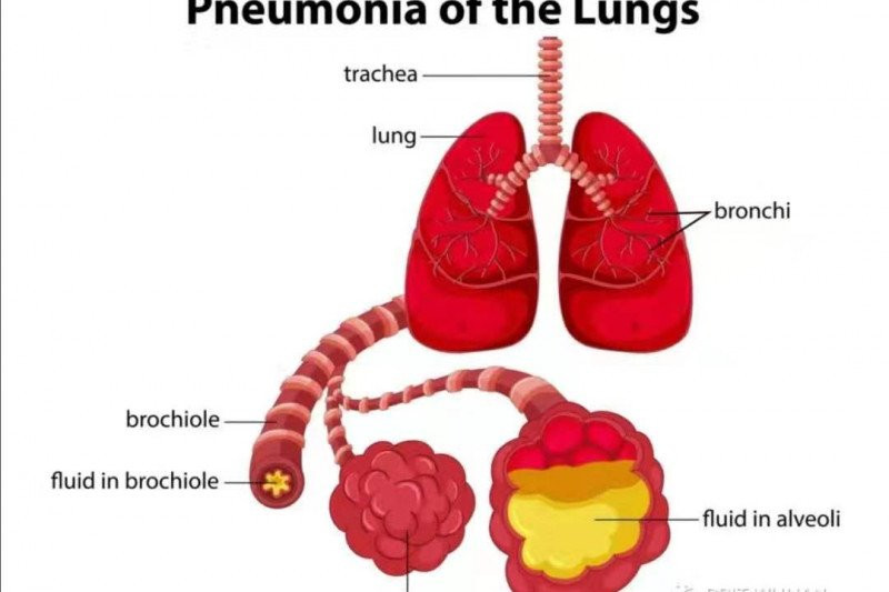 Pneumonia, Penyakit Pernapasan yang Sering Dianggap Sebagai Flu Biasa