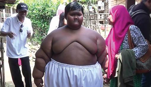 Arya Permana si Penderita Obesitas, Dulu Berat Badan 193 Kg, Kini Mulai Langsing